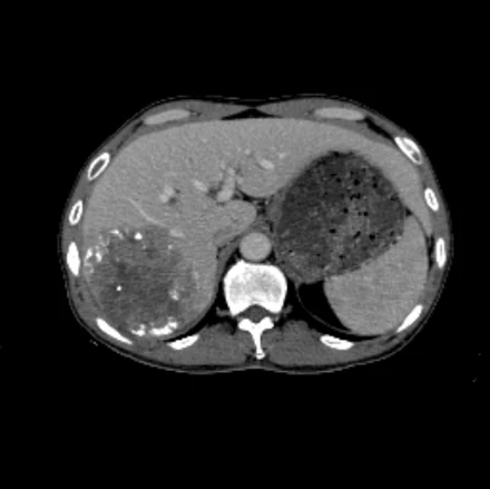 Real post-TACE CT of patient 1