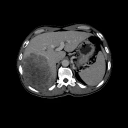 Pre-TACE CT of patient 1