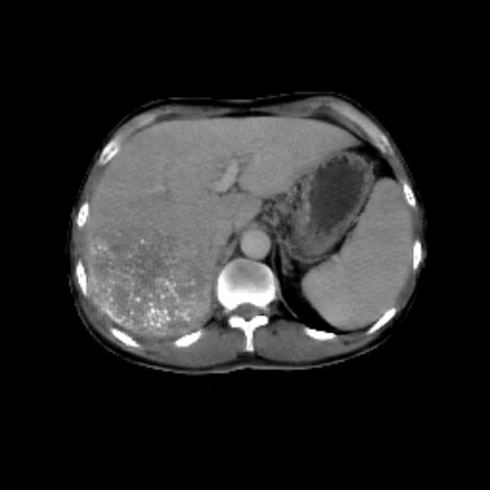 Virtual post-TACE CT of patient 1, generated by RadWorld