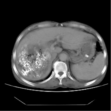 Real post-TACE CT of patient 2