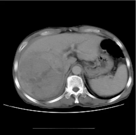 Pre-TACE CT of patient 2
