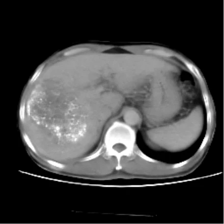 Virtual post-TACE CT of patient 2, generated by RadWorld