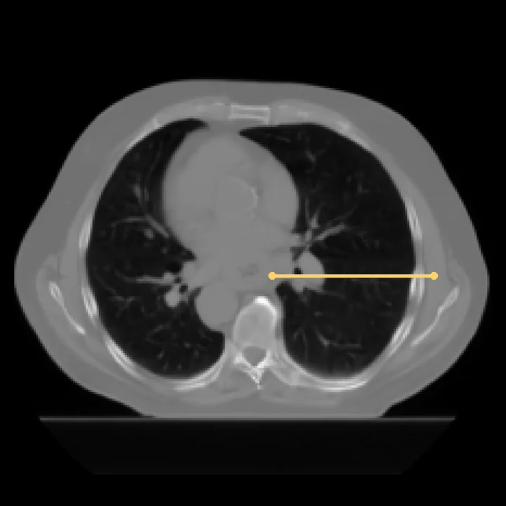 CT generated by RadWorld from the cone-beam CT, with the profile line marked