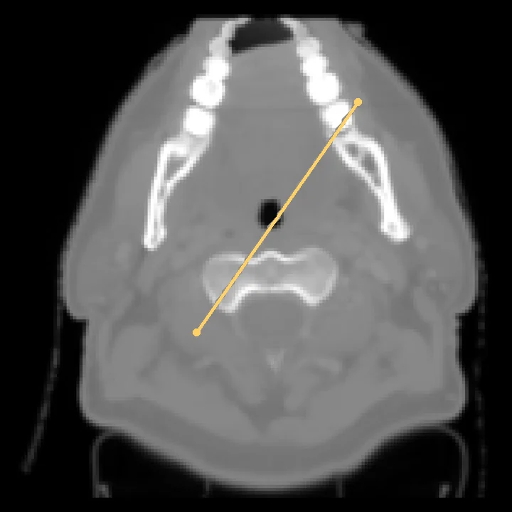 Real CT of the same patient, with the profile line marked