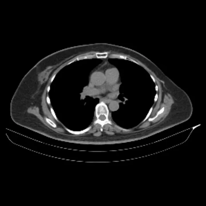 Input non-contrast chest CT