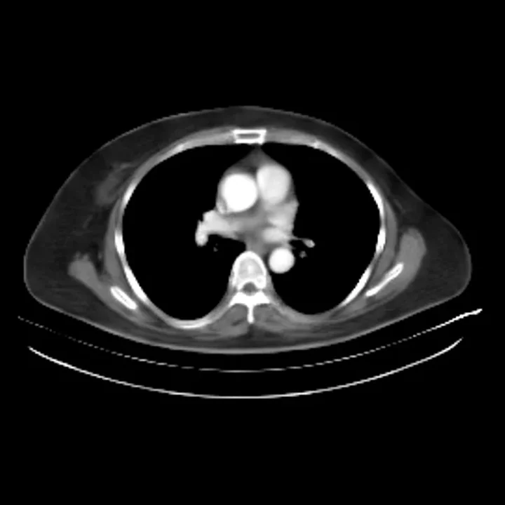 Arterial-phase CT generated by RadWorld from the non-contrast CT