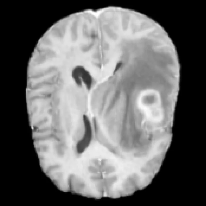 T1CE generated by RadWorld from T1, T2 and FLAIR, post-treatment glioma