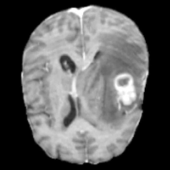 Real T1CE of the same patient