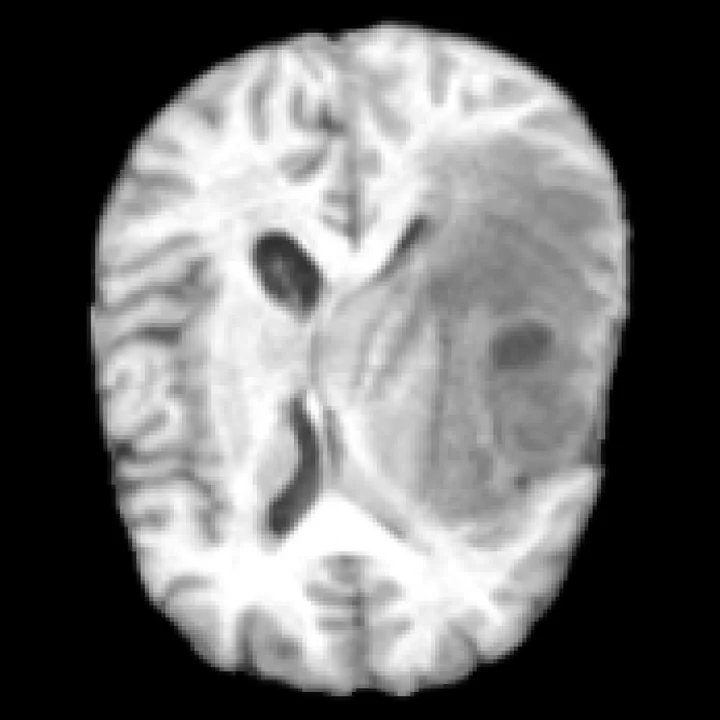 Input T1 MRI